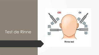 Pruebas Acumetricas.pptx. rinne weber... | PPTX