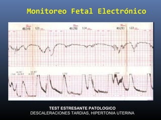 Monitoreo Fetal Electrónico
TEST ESTRESANTE PATOLOGICO
DESCALERACIONES TARDIAS, HIPERTONIA UTERINA
 