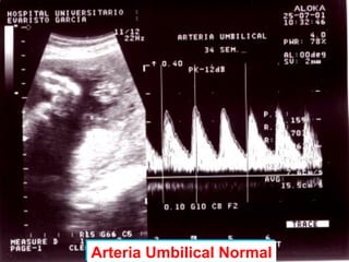 Arteria Umbilical NormalArteria Umbilical Normal
 
