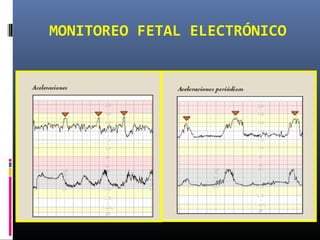 MONITOREO FETAL ELECTRÓNICO
 