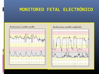 MONITOREO FETAL ELECTRÓNICO
 