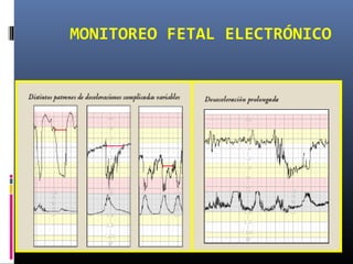 MONITOREO FETAL ELECTRÓNICO
 