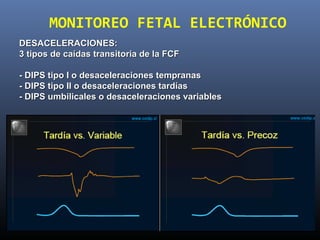 DESACELERACIONES:DESACELERACIONES:
3 tipos de caídas transitoria de la FCF3 tipos de caídas transitoria de la FCF
- DIPS tipo I o desaceleraciones tempranas- DIPS tipo I o desaceleraciones tempranas
- DIPS tipo II o desaceleraciones tardías- DIPS tipo II o desaceleraciones tardías
- DIPS umbilicales o desaceleraciones variables- DIPS umbilicales o desaceleraciones variables
MONITOREO FETAL ELECTRÓNICO
 