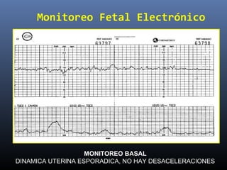 Monitoreo Fetal Electrónico
MONITOREO BASAL
DINAMICA UTERINA ESPORADICA, NO HAY DESACELERACIONES
 