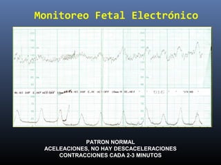 Monitoreo Fetal Electrónico
PATRON NORMAL
ACELEACIONES, NO HAY DESCACELERACIONES
CONTRACCIONES CADA 2-3 MINUTOS
 