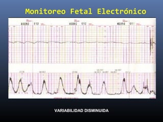 Monitoreo Fetal Electrónico
VARIABILIDAD DISMINUIDA
 