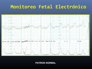 Monitoreo Fetal Electrónico
PATRON NORMAL
 