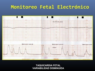 Monitoreo Fetal Electrónico
TAQUICARDIA FETAL
VARIABILIDAD DISMINUIDA
 