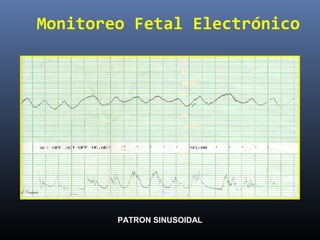 Monitoreo Fetal Electrónico
PATRON SINUSOIDAL
 