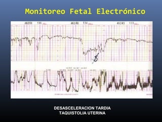 Monitoreo Fetal Electrónico
DESASCELERACION TARDIA
TAQUISTOLIA UTERINA
 