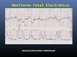 Monitoreo Fetal Electrónico
DESACELERACIONES TEMPRANAS
 