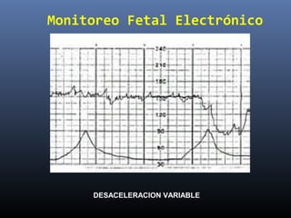 Monitoreo Fetal Electrónico
DESACELERACION VARIABLE
 