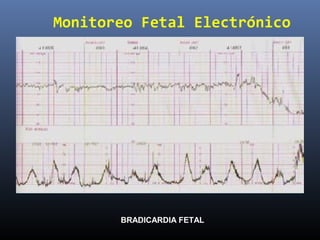 Monitoreo Fetal Electrónico
BRADICARDIA FETAL
 