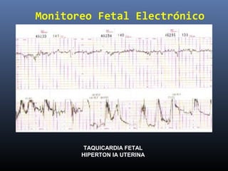 Monitoreo Fetal Electrónico
TAQUICARDIA FETAL
HIPERTON IA UTERINA
 
