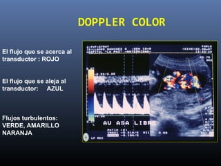 El flujo que se acerca al
transductor : ROJO
El flujo que se aleja al
transductor: AZUL
Flujos turbulentos:
VERDE, AMARILLO
NARANJA
DOPPLER COLOR
 