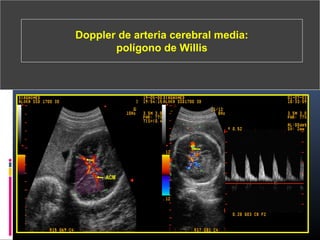 Doppler de arteria cerebral media:
polígono de Willis
 