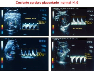 Cociente cerebro placentario normal >1.0
 