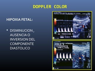 DOPPLER COLOR
HIPOXIA FETAL:
 DISMINUCION ,
AUSENCIA O
INVERSION DEL
COMPONENTE
DIASTOLICO
 