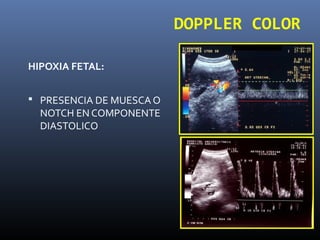 DOPPLER COLOR
HIPOXIA FETAL:
 PRESENCIA DE MUESCA O
NOTCH EN COMPONENTE
DIASTOLICO
 