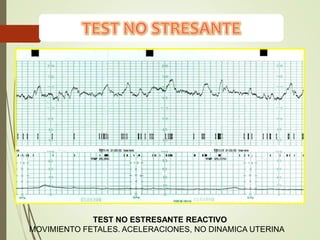 TEST NO ESTRESANTE REACTIVO
MOVIMIENTO FETALES. ACELERACIONES, NO DINAMICA UTERINA
 