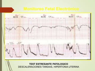 Monitoreo Fetal Electrónico
TEST ESTRESANTE PATOLOGICO
DESCALERACIONES TARDIAS, HIPERTONIA UTERINA
 
