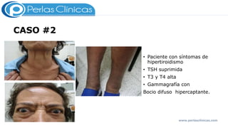 CASO #2
• Paciente con síntomas de
hipertiroidismo
• TSH suprimida
• T3 y T4 alta
• Gammagrafía con
Bocio difuso hipercaptante.
www.perlasclinicas.com
 