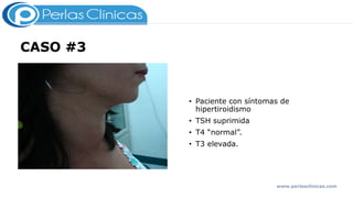 CASO #3
• Paciente con síntomas de
hipertiroidismo
• TSH suprimida
• T4 “normal”.
• T3 elevada.
www.perlasclinicas.com
 