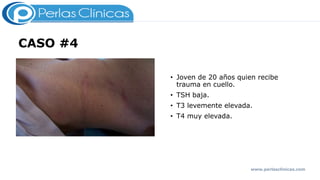 CASO #4
• Joven de 20 años quien recibe
trauma en cuello.
• TSH baja.
• T3 levemente elevada.
• T4 muy elevada.
www.perlasclinicas.com
 