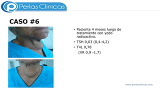 CASO #6
• Paciente 4 meses luego de
tratamiento con yodo
radioactivo.
• TSH 0,03 (0,4-4,2)
• T4L 0,78
(VR 0.9 -1.7)
www.perlasclinicas.com
 