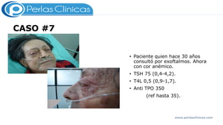 CASO #7
• Paciente quien hace 30 años
consultó por exoftalmos. Ahora
con cor anémico.
• TSH 75 (0,4-4,2).
• T4L 0,5 (0,9-1,7).
• Anti TPO 350
(ref hasta 35).
www.perlasclinicas.com
 