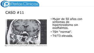 CASO #11
• Mujer de 50 años con
síntomas de
hipertiroidismo sin
exoftalmos.
• TSH “normal”.
• T4/T3 elevada.
 