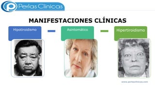 MANIFESTACIONES CLÍNICAS
Hipotiroidismo Asintomático Hipertiroidismo
www.perlasclinicas.com
 