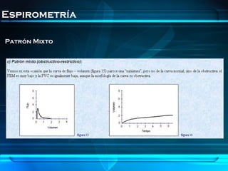 Espirometría

Patrón Mixto
 