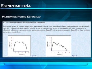 Espirometría

Patrón de Pobre Esfuerzo
 