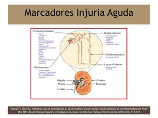 Patrick T. Murray. Potential use of biomarkers in acute kidney injury: report and summary of recommendations from
the 10th Acute Dialysis Quality Initiative consensus conference. Kidney International (2014) 85, 513–521
Marcadores Injuria Aguda
 