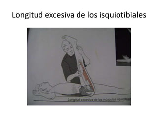 Longitud excesiva de los isquiotibiales
 
