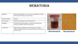 Hematuria
 