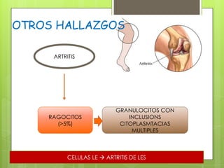 OTROS HALLAZGOS
ARTRITIS

RAGOCITOS
(>5%)

GRANULOCITOS CON
INCLUSIONS
CITOPLASMTACIAS
MULTIPLES

CELULAS LE  ARTRITIS DE LES

 