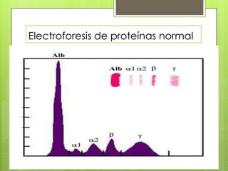 Electroforesis de proteínas normal

 