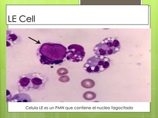 LE Cell

Celula LE es un PMN que contiene el nucleo fagocitado

 
