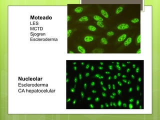 Moteado
LES
MCTD
Sjogren
Escleroderma

Nucleolar
Escleroderma
CA hepatocelular

 