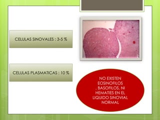 CELULAS SINOVALES : 3-5 %

CELULAS PLASMATICAS : 10 %
NO EXISTEN
EOSINOFILOS
, BASOFILOS, NI
HEMATIES EN EL
LIQUIDO SINOVIAL
NORMAL

 