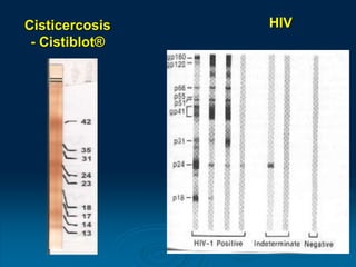 Cisticercosis
- Cistiblot®
HIV
 