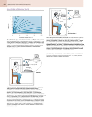 PARTE 2 • Diagnóstico y Evaluación de Enfermedades Respiratorias
PARTE 2 • Diagnóstico y Evaluación de Enfermedades Respiratorias
PARTE 2 • Diagnóstico y Evaluación de Enfermedades Respiratorias
435.e2
GALERÍA DE IMÁGENES eFIGURE
eFigure 25-1 Relación entre la presión de accionamiento (eje x) y el flujo de aire (eje y) a través
eFigure 25-1 Relación entre la presión de accionamiento (eje x) y el flujo de aire (eje y) a través
de una serie de orificios críticos de diámetros variables (en mm). El uso de esta familia de curvas,
de una serie de orificios críticos de diámetros variables (en mm). El uso de esta familia de curvas,
es posible determinar el diámetro de un orificio crítico en un paciente con obstrucción de la vía aérea
superior. Suponiendo una presión impulsora de 100 cm H2 O, el diámetro está dada por la curva más
superior. Suponiendo una presión impulsora de 100 cm H2 O, el diámetro está dada por la curva más
superior. Suponiendo una presión impulsora de 100 cm H2 O, el diámetro está dada por la curva más
cercana a la corriente máxima observada en la meseta de flujo obtenido del bucle de flujo-volumen
obtenida del paciente. Las curvas se construyeron mediante el uso de resistencias externas
graduadas en un sujeto normal.
50 100 150
10
12
8
6
4
2
0
3
6
54
9
8
11
10
15 13
17
0 200
La conducción de presión (cm H 2 O)
La conducción de presión (cm H 2 O)
La conducción de presión (cm H 2 O)
eFigure 25-2 Volumen (de tipo abierto) pletismógrafo. En este constantpressure, el tipo de volumen
eFigure 25-2 Volumen (de tipo abierto) pletismógrafo. En este constantpressure, el tipo de volumen
eFigure 25-2 Volumen (de tipo abierto) pletismógrafo. En este constantpressure, el tipo de volumen
variable de pletismógrafo, el sujeto también respira a través de un aparato de obturación /
neumotacógrafo, que normalmente se encuentra fuera de la propia pletismógrafo. El obturador está
abierto para la respiración corriente, la medición de la resistencia de las vías respiratorias, y la
espirometría. Está cerrado para la medición de volumen de gas torácico. En el modo de obturador
cerrado, la presión de la boca se mide mediante un transductor ( 1) y se aproxima a la presión alveolar sin
cerrado, la presión de la boca se mide mediante un transductor ( 1) y se aproxima a la presión alveolar sin
cerrado, la presión de la boca se mide mediante un transductor ( 1) y se aproxima a la presión alveolar sin
flujo y los cambios de volumen pequeño. El flujo medidas neumotacógrafo a través de otro transductor ( 2, por
flujo y los cambios de volumen pequeño. El flujo medidas neumotacógrafo a través de otro transductor ( 2, por
flujo y los cambios de volumen pequeño. El flujo medidas neumotacógrafo a través de otro transductor ( 2, por
encima de la neumotacógrafo). El flujo se integra electrónicamente para obtener volumen. Los cambios
en el volumen del pletismógrafo, lo que refleja el movimiento de la pared torácica, se miden con un
espirómetro y un transductor de volumen de desplazamiento lineal (LVDT). El espirómetro ilustrado es un
espirómetro de cierre hidráulico Krogh con buena respuesta de frecuencia y la impedancia muy pequeña
de desplazamiento de gas. Un neumotacógrafo de baja resistencia (medidor de caudal) con un integrador
rápido, y libre de error puede ser utilizado en su lugar. El procesamiento se realiza generalmente por la
computadora y permite lento y forzado maniobras de capacidad vital también. Sin embargo, ninguno de
estos enfoques es de rutina.
neumotacógrafo
obturador
espirómetro
2
ordenador
LVDT
1 transductor
eFigure 25-3 Presión-volumen (o flujo) pletismógrafo. Este tipo de pletismógrafo combina las
eFigure 25-3 Presión-volumen (o flujo) pletismógrafo. Este tipo de pletismógrafo combina las
eFigure 25-3 Presión-volumen (o flujo) pletismógrafo. Este tipo de pletismógrafo combina las
características de los tipos cerrada y abierta. El sujeto respira a través de un aparato de
obturación / neumotacógrafo. El obturador está abierto para la respiración corriente, la medición
de la resistencia de las vías respiratorias, y la espirometría. Está cerrado para la medición de
volumen de gas torácico. En la posición cerrada, presión en la boca (presión alveolar) se mide
mediante un transductor ( parte superior). El neumotacógrafo en la boca (neumotacógrafo 1) mide
mediante un transductor ( parte superior). El neumotacógrafo en la boca (neumotacógrafo 1) mide
mediante un transductor ( parte superior). El neumotacógrafo en la boca (neumotacógrafo 1) mide
el flujo de aire con otro transductor ( medio). Este flujo de aire en la boca se integra para obtener el
el flujo de aire con otro transductor ( medio). Este flujo de aire en la boca se integra para obtener el
el flujo de aire con otro transductor ( medio). Este flujo de aire en la boca se integra para obtener el
volumen inhalado y exhalado por la boca. Los cambios en el pletismógrafo o volumen de la caja
resultante de los movimientos de la pared torácica se miden por un neumotacógrafo en la pared
del pletismógrafo (neumotacógrafo 2) con un tercer transductor ( fondo),
del pletismógrafo (neumotacógrafo 2) con un tercer transductor ( fondo),
y esta señal se integra para obtener el cambio de volumen del tórax. Las señales procedentes de los tres
transductores normalmente son procesadas por ordenador para obtener lento y obligados capacidades
vitales, así como los volúmenes de resistencia y de gas torácico.
neumotacógrafo 2
neumotacógrafo 1
Obturador
transductor
Flow
(L
/
s)
 
