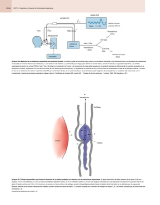 PARTE 2 • Diagnóstico y Evaluación de Enfermedades Respiratorias
PARTE 2 • Diagnóstico y Evaluación de Enfermedades Respiratorias
PARTE 2 • Diagnóstico y Evaluación de Enfermedades Respiratorias
435.e4
eFigure 25-6 Medición de la resistencia respiratoria por oscilación forzada. Un altavoz puede ser accionado para producir una oscilación sinusoidal a una frecuencia única, una secuencia de oscilaciones
eFigure 25-6 Medición de la resistencia respiratoria por oscilación forzada. Un altavoz puede ser accionado para producir una oscilación sinusoidal a una frecuencia única, una secuencia de oscilaciones
eFigure 25-6 Medición de la resistencia respiratoria por oscilación forzada. Un altavoz puede ser accionado para producir una oscilación sinusoidal a una frecuencia única, una secuencia de oscilaciones
sinusoidales en diversas frecuencias individuales, o una señal de ruido aleatorio. La señal de flujo se integra para obtener el volumen tidal o, al final del estudio, la capacidad inspiratoria. Las señales
registradas de presión en la boca (PMO) y flujo ( Vmo ) Se dirige a un analizador de Fourier, y el componente de cada señal causada por la oscilación aplicada se diferencia de los cambios causados ​​por la
registradas de presión en la boca (PMO) y flujo ( Vmo ) Se dirige a un analizador de Fourier, y el componente de cada señal causada por la oscilación aplicada se diferencia de los cambios causados ​​por la
registradas de presión en la boca (PMO) y flujo ( Vmo ) Se dirige a un analizador de Fourier, y el componente de cada señal causada por la oscilación aplicada se diferencia de los cambios causados ​​por la
respiración corriente. Impedancia (Zrs) se calcula a través de una amplia gama de frecuencias. La impedancia se subdivide en las y fuera de fase de componentes en fase de las señales primarias. La señal
en fase es la resistencia del sistema respiratorio total (RR), y la señal fuera de fase es la reactancia (Xrs), a veces llamada la parte imaginaria de la impedancia. La reactancia está relacionada con el
cumplimiento y inertance del sistema respiratorio (véase el texto). ( Modificado de Hughes JMB, orgullo NB: Pruebas de función pulmonar, Londres, 1999, WB Saunders, p 35.)
cumplimiento y inertance del sistema respiratorio (véase el texto). ( Modificado de Hughes JMB, orgullo NB: Pruebas de función pulmonar, Londres, 1999, WB Saunders, p 35.)
cumplimiento y inertance del sistema respiratorio (véase el texto). ( Modificado de Hughes JMB, orgullo NB: Pruebas de función pulmonar, Londres, 1999, WB Saunders, p 35.)
cumplimiento y inertance del sistema respiratorio (véase el texto). ( Modificado de Hughes JMB, orgullo NB: Pruebas de función pulmonar, Londres, 1999, WB Saunders, p 35.)
Oscilador
Hora
Midtidal volumen
pulmonar (MTLV)
Resistencia
(RRS)
En fase
Resistencia reactiva
(Xrs)
Fuera de
fase
APARATO
ANÁLISIS
análisis de
Fourier
PMO Vmo PMO Vmo
Altoparlante
•
•
V •
PMO / Vmo
•
Impedancia
(Zrs)
eFigure 25-7 Dibujo esquemático que ilustra la posición de un balón esofágico en relación con las estructuras adyacentes. El globo está hecho de látex (espesor de la pared, 0,06 mm;
eFigure 25-7 Dibujo esquemático que ilustra la posición de un balón esofágico en relación con las estructuras adyacentes. El globo está hecho de látex (espesor de la pared, 0,06 mm;
eFigure 25-7 Dibujo esquemático que ilustra la posición de un balón esofágico en relación con las estructuras adyacentes. El globo está hecho de látex (espesor de la pared, 0,06 mm;
longitud, 10 cm; circunferencia, 3,5 cm). El tubo es polietileno (diámetro interno, 0,14 cm; diámetro exterior, 0,19 cm) con agujeros colocados en una disposición en espiral en la porción interior del
globo. El globo se llena con 0,2 a 0,4 ml de aire y se coloca en el tercio inferior del esófago. presión intraesofágica grabado desde el catéter dentro del balón se ve afectada por los siguientes
factores, además de la presión transpulmonar estática: presión retráctil de pared del balón ( 1), presión causada por la tensión de esófago de reposo ( 2), y la presión causada por las estructuras del
factores, además de la presión transpulmonar estática: presión retráctil de pared del balón ( 1), presión causada por la tensión de esófago de reposo ( 2), y la presión causada por las estructuras del
factores, además de la presión transpulmonar estática: presión retráctil de pared del balón ( 1), presión causada por la tensión de esófago de reposo ( 2), y la presión causada por las estructuras del
factores, además de la presión transpulmonar estática: presión retráctil de pared del balón ( 1), presión causada por la tensión de esófago de reposo ( 2), y la presión causada por las estructuras del
factores, además de la presión transpulmonar estática: presión retráctil de pared del balón ( 1), presión causada por la tensión de esófago de reposo ( 2), y la presión causada por las estructuras del
mediastino ( 3),
mediastino ( 3),
incluyendo las pulsaciones del corazón ( 4).
incluyendo las pulsaciones del corazón ( 4).
Corazón
al
transductor
Esófago
Globo
1
2
4
3
 