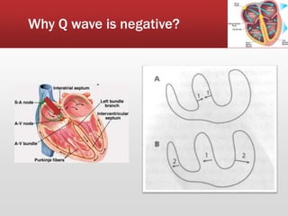 Why Q wave is negative?
2
 