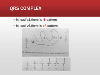 QRS COMPLEX
▪ In lead V1,there is rS pattern
▪ In lead V6,there is qR pattern.
 