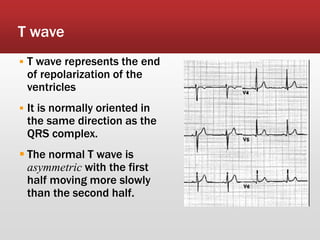 T wave
 T wave represents the end
of repolarization of the
ventricles
 It is normally oriented in
the same direction as the
QRS complex.
 The normal T wave is
asymmetric with the first
half moving more slowly
than the second half.
 