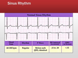 Sinus Rhythm
 