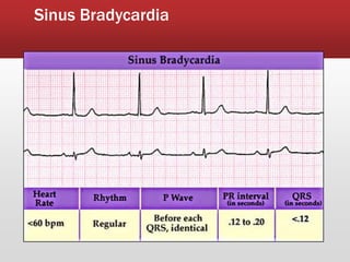 Sinus Bradycardia
 